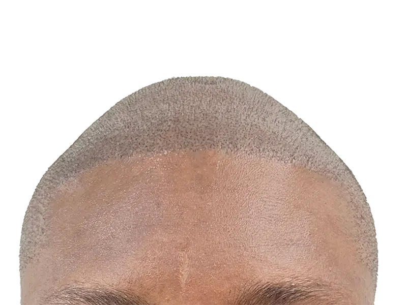 Hair transplant result: Close-up of restored hairline. Even, dense hair growth after hair restoration procedure.