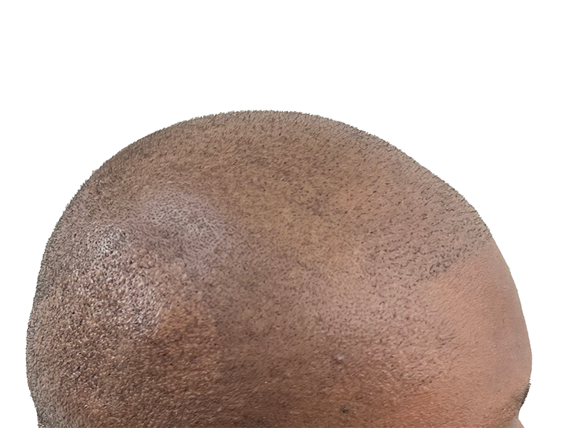 Hair transplant close-up: Short, evenly distributed hair growth on scalp. Hair restoration progress. Possible before/after result.