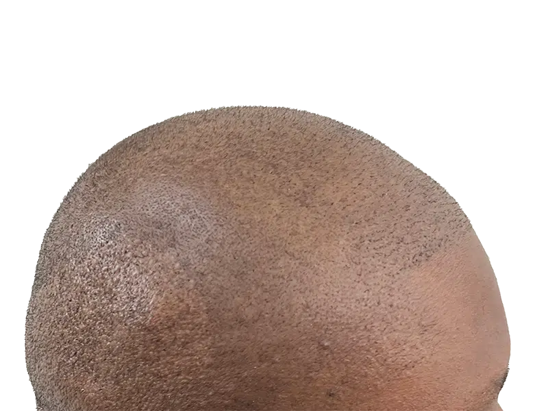 Hair transplant close-up: Short, evenly distributed hair growth on scalp. Hair restoration progress. Possible before/after result.