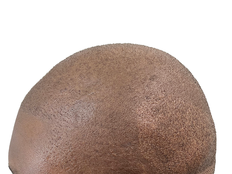 Close-up of scalp with healthy, dark brown hair. Hair restoration result? Even hair distribution, no transplant visible.