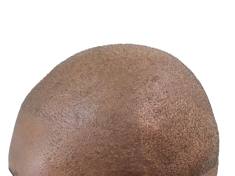 Close-up of scalp with healthy, dark brown hair. Hair restoration result? Even hair distribution, no transplant visible.