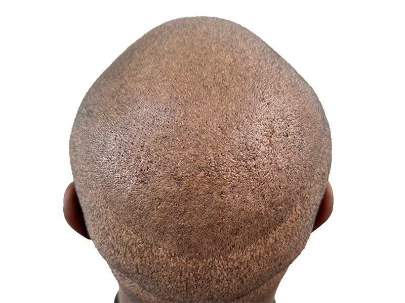 Hair transplant result: Close-up of scalp showing newly implanted follicles. Hair restoration procedure. Before & after potential.