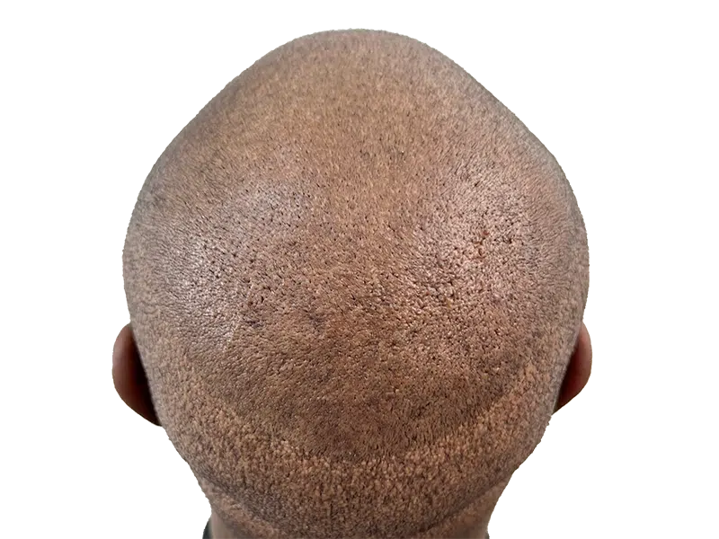 Hair transplant result: Close-up of scalp showing newly implanted follicles. Hair restoration procedure. Before & after potential.