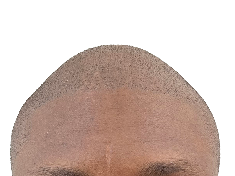 Hair transplant result: Defined hairline on African American/Hispanic man. Restored, youthful appearance. Hair restoration success.