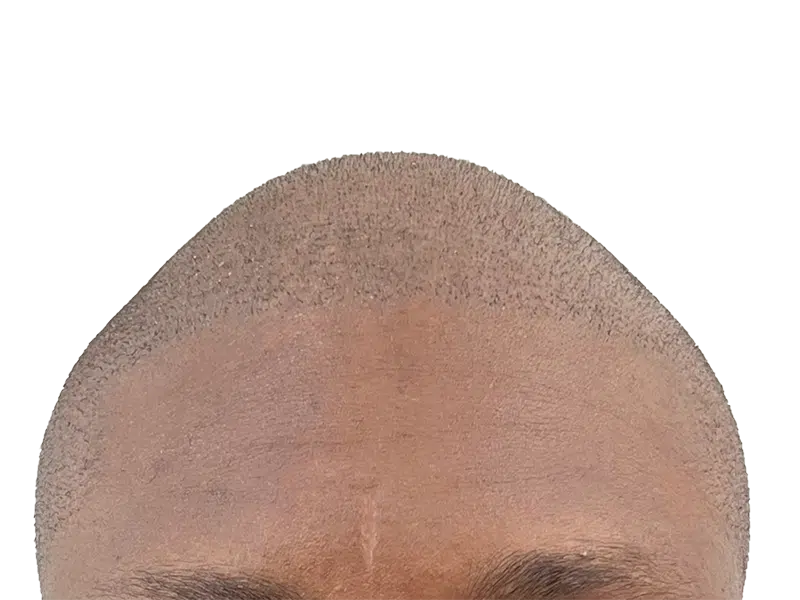 Hair transplant result: Defined hairline on African American/Hispanic man. Restored, youthful appearance. Hair restoration success.