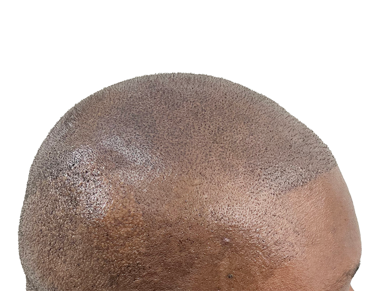 Hair transplant result: African American man's scalp showing dense, uniform hair growth. Successful hair restoration procedure.