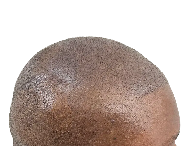 Hair transplant result: African American man's scalp showing dense, uniform hair growth. Successful hair restoration procedure.