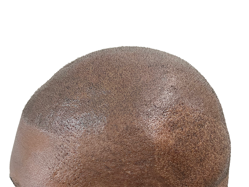 Hair transplant results: African American man's dense, natural-looking hair growth. Hair restoration success.