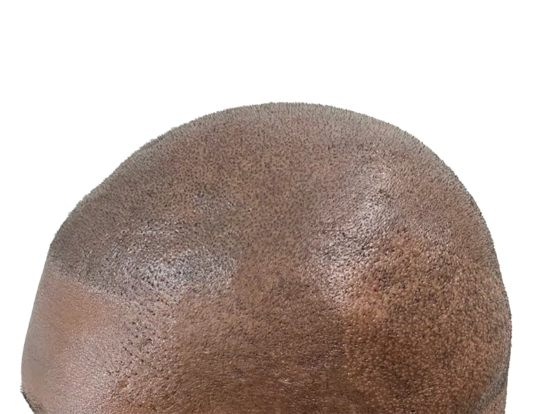 Hair transplant results: African American man's dense, natural-looking hair growth. Hair restoration success.