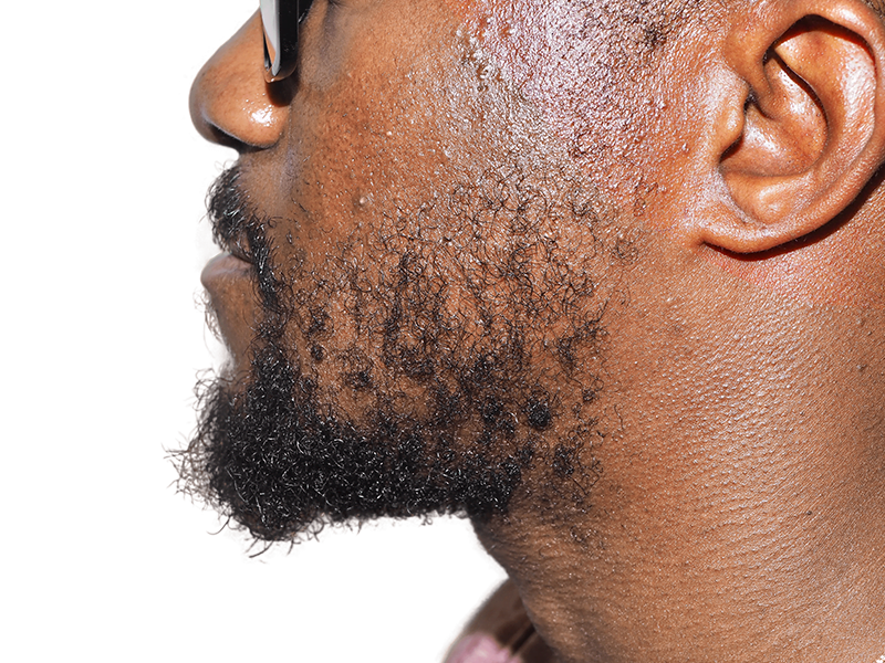 African American man's beard. Potential hair transplant result? Thick, healthy beard. Hair restoration services available.