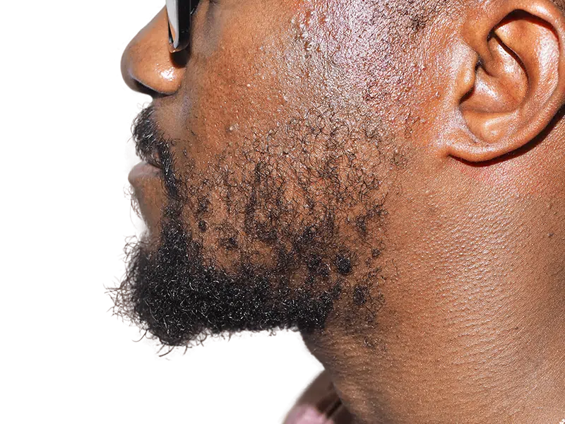 African American man's beard. Potential hair transplant result? Thick, healthy beard. Hair restoration services available.