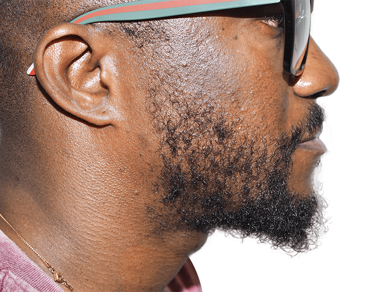 African American man with healthy, full hair. Possible hair transplant result. Beard and glasses. Hair restoration success.