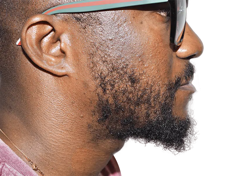 African American man with healthy, full hair. Possible hair transplant result. Beard and glasses. Hair restoration success.