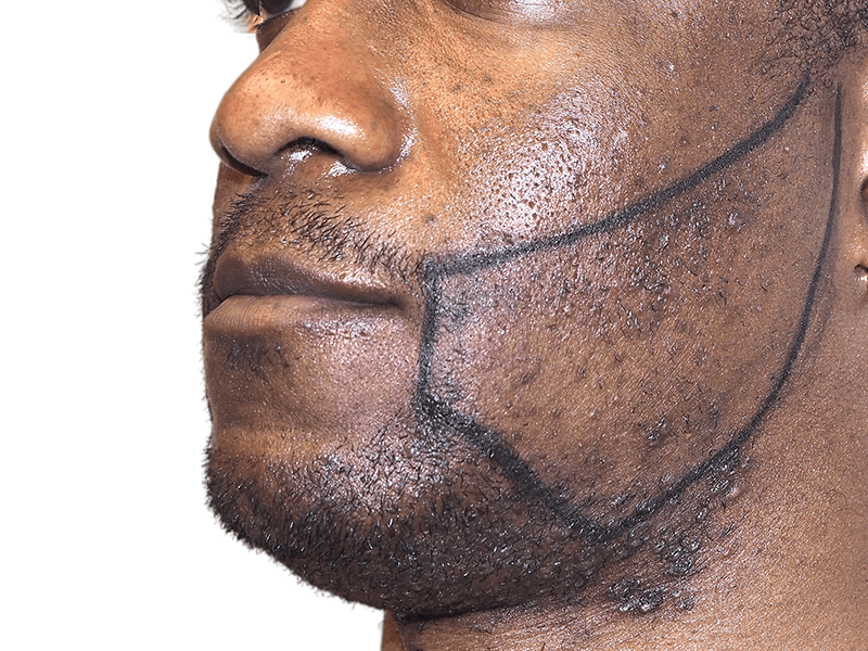 Beard transplant planning on African American man. Outlined beard area shows desired hair restoration results.