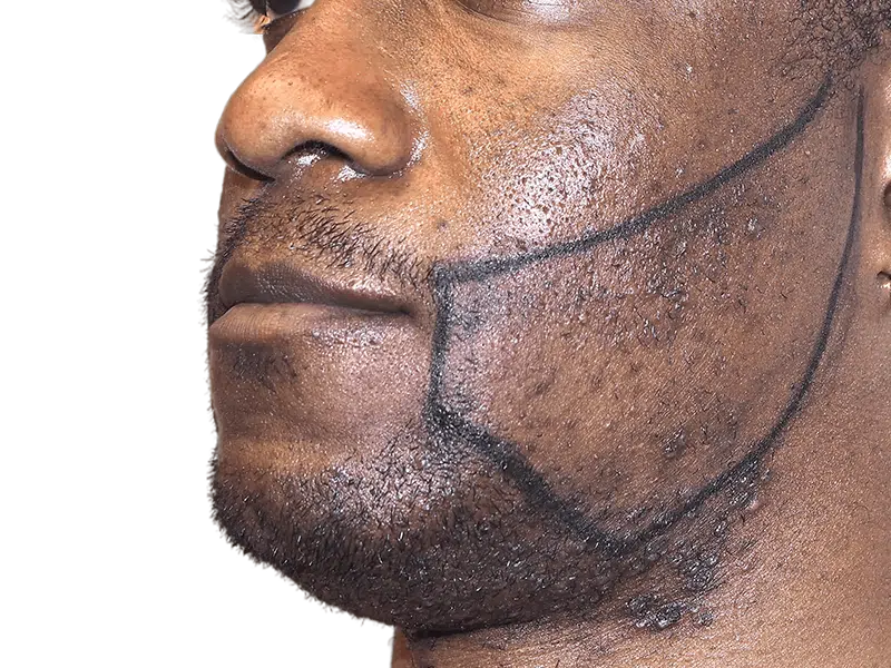 Beard transplant planning on African American man. Outlined beard area shows desired hair restoration results.