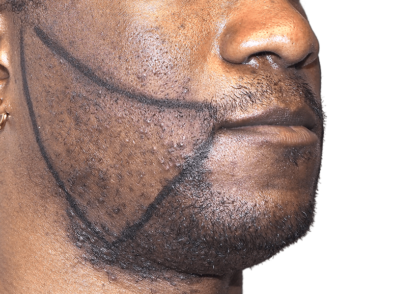 Beard transplant planning on African American man. Outlined beard shape for hair restoration. No before/after shown.