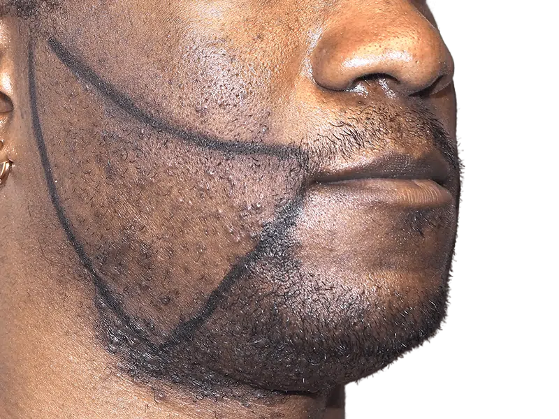 Beard transplant planning on African American man. Outlined beard shape for hair restoration. No before/after shown.