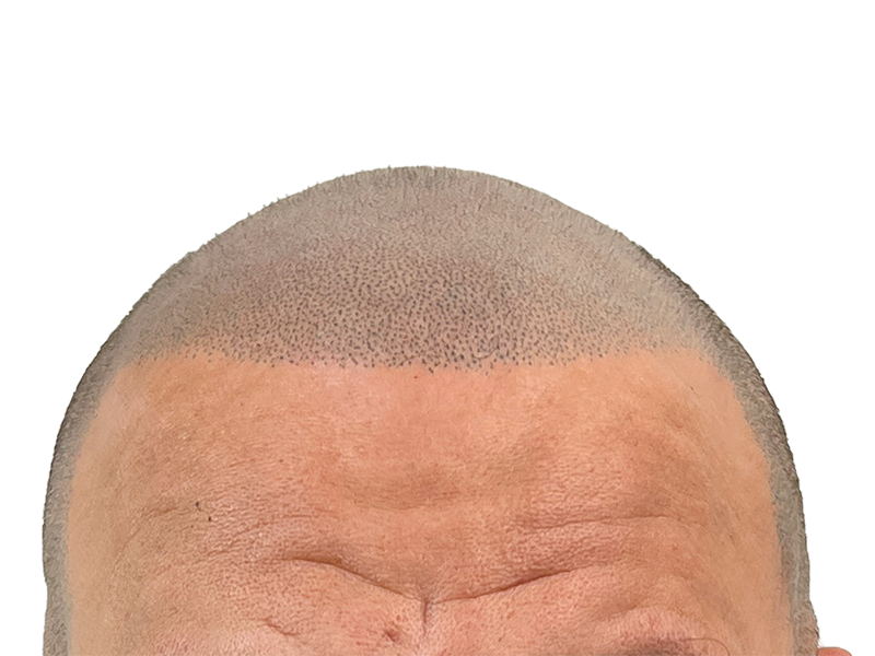 Hair transplant close-up: denser follicles, restored hairline. Caucasian male. Hair restoration results.