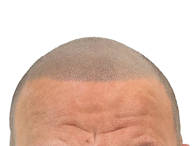 Hair transplant close-up: denser follicles, restored hairline. Caucasian male. Hair restoration results.