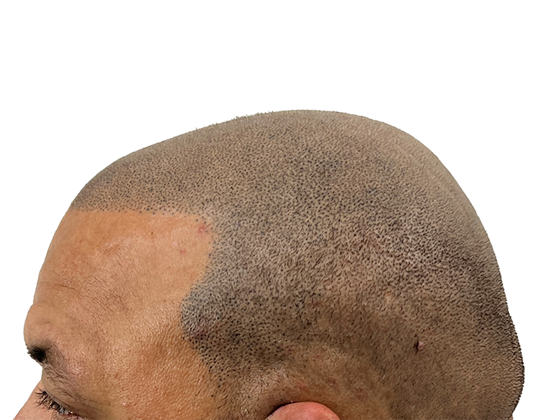 Hair transplant result: Dense, restored hair on a Black/Hispanic man. Before/after showing improved density. Hair restoration success.