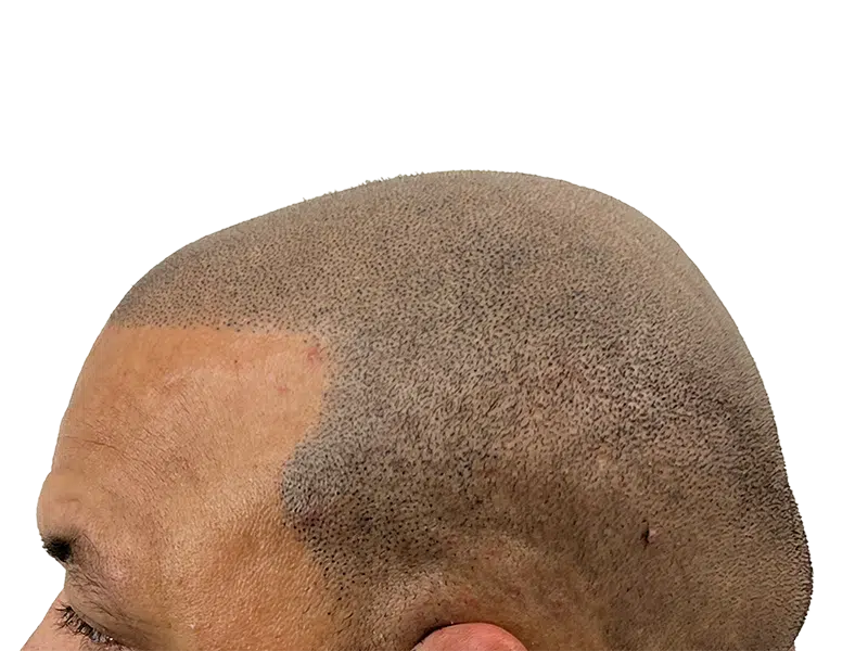 Hair transplant result: Dense, restored hair on a Black/Hispanic man. Before/after showing improved density. Hair restoration success.