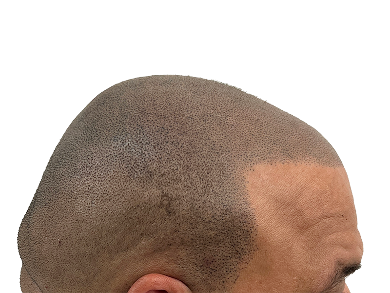Hair transplant before & after: Receding hairline restored. Fuller, denser hairline achieved with hair restoration procedure.
