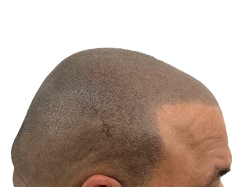 Hair transplant before & after: Receding hairline restored. Fuller, denser hairline achieved with hair restoration procedure.