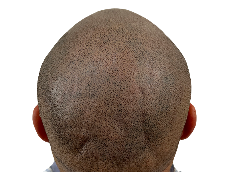 Hair transplant close-up: Shaved scalp shows dense follicle placement. Before/after hair restoration results for fuller hair.