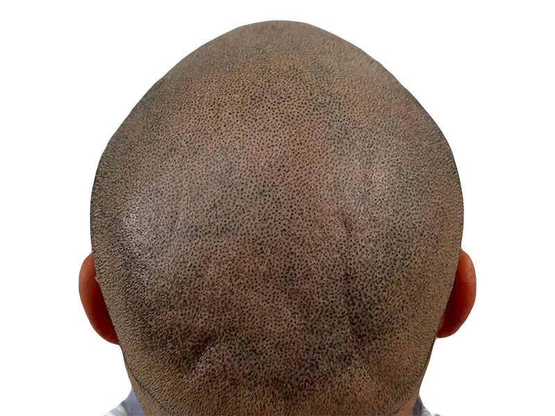Hair transplant close-up: Shaved scalp shows dense follicle placement. Before/after hair restoration results for fuller hair.