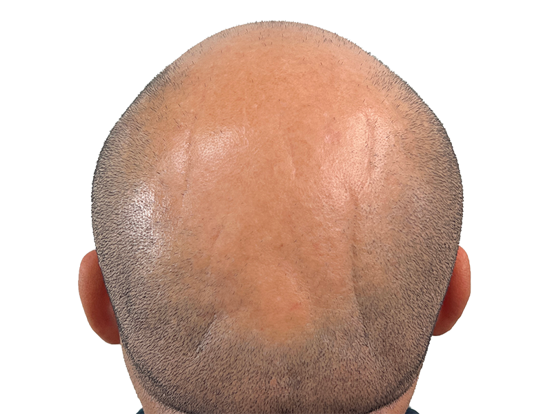 Hair transplant result: Bald crown with short hair around sides. Hair restoration procedure example.