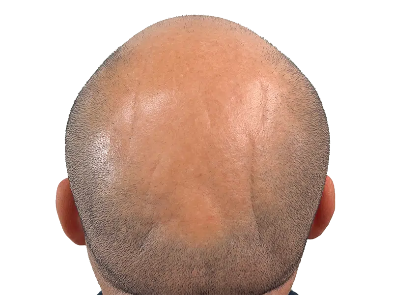 Hair transplant result: Bald crown with short hair around sides. Hair restoration procedure example.