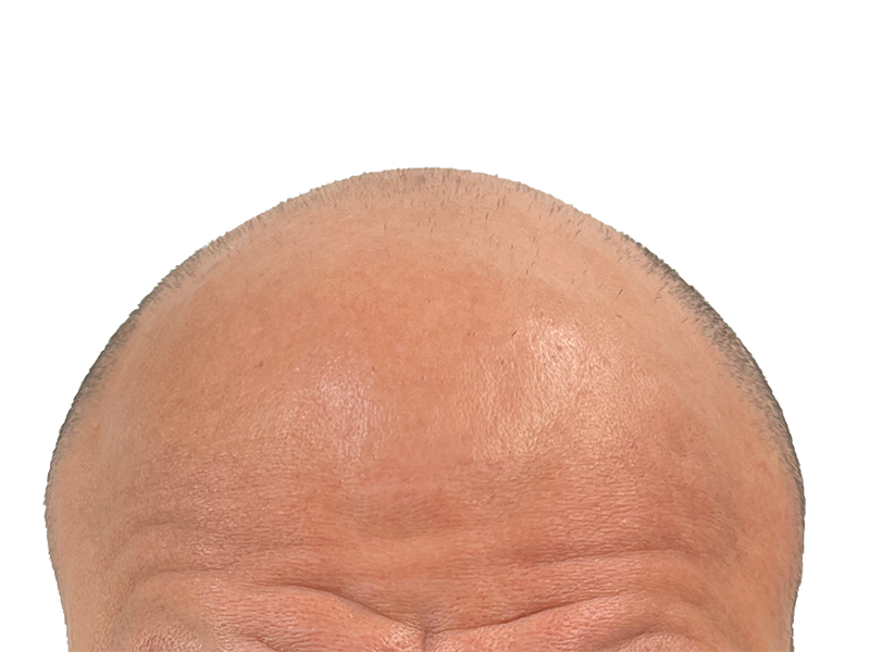 Receding hairline & thinning hair. Hair restoration can help. See hair transplant options for balding.