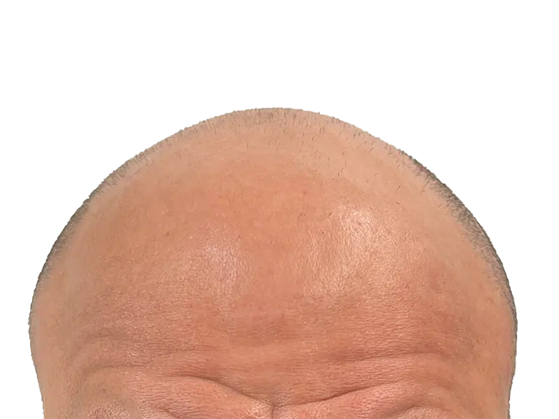 Receding hairline & thinning hair. Hair restoration can help. See hair transplant options for balding.