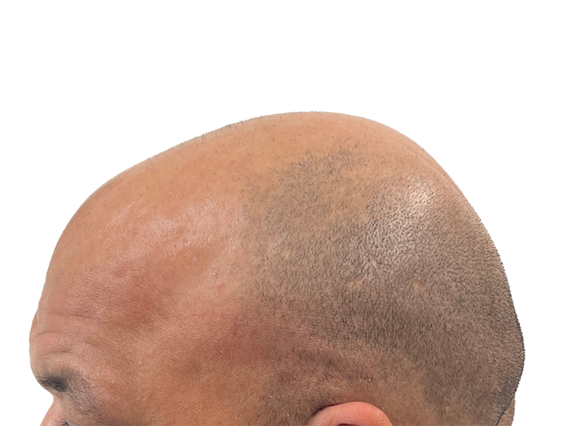Receding hairline & thinning hair. Potential hair transplant candidate. Before hair restoration treatment.