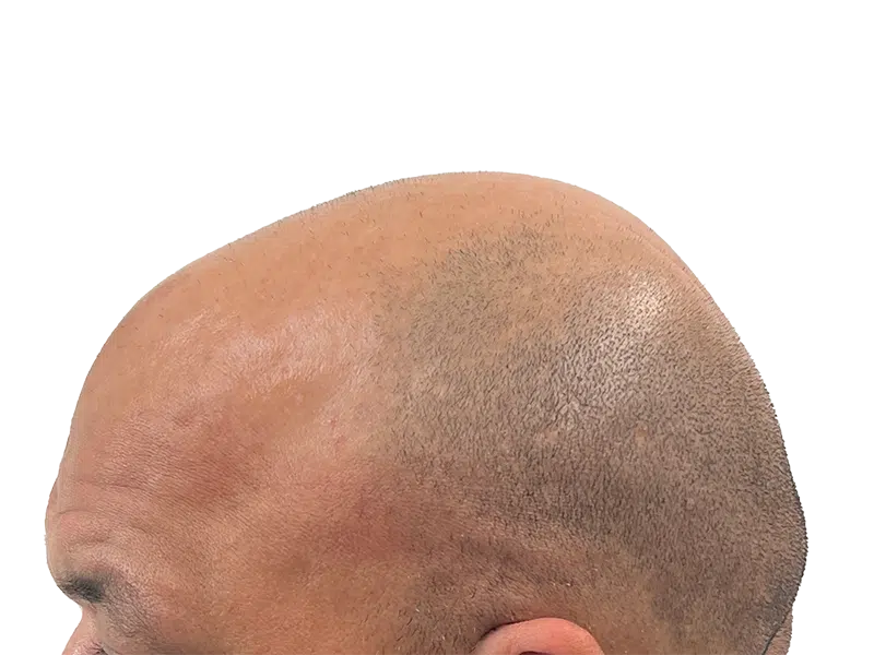 Receding hairline & thinning hair. Potential hair transplant candidate. Before hair restoration treatment.