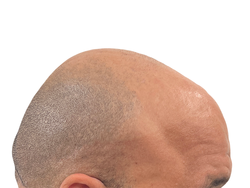 Close-up of scalp showing hair restoration results. Possible hair transplant before/after. Light skin tone, short hair.