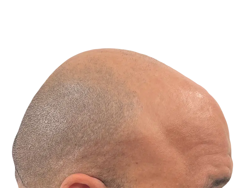 Close-up of scalp showing hair restoration results. Possible hair transplant before/after. Light skin tone, short hair.