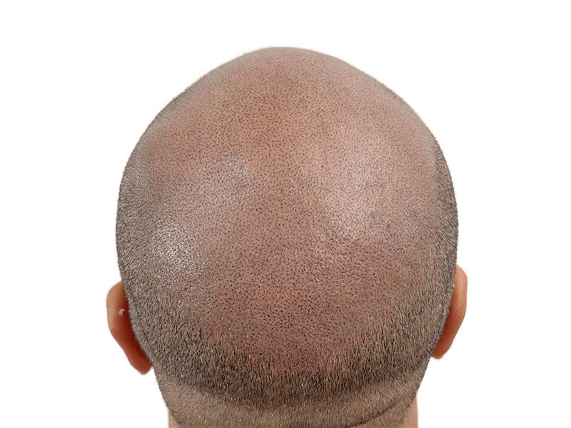 Hair transplant after: Shaved head showing transplanted follicles. Hair restoration results. Before/after hair loss solution.