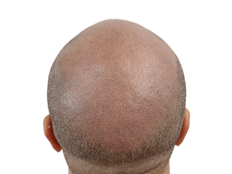 Hair transplant after: Shaved head showing transplanted follicles. Hair restoration results. Before/after hair loss solution.
