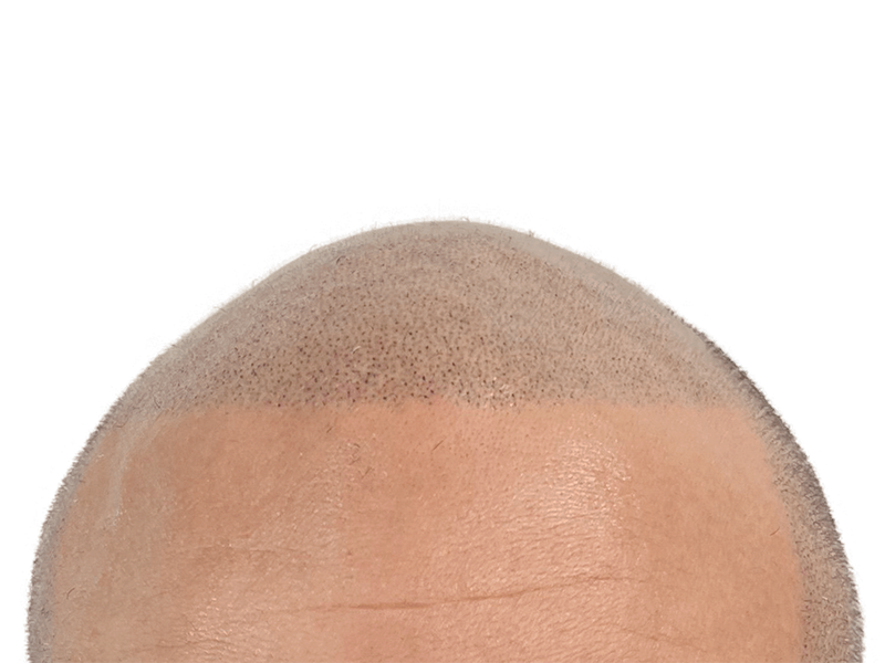 Hair transplant result: New hairline with short, dense hair growth. Hair restoration procedure visible on light skin.