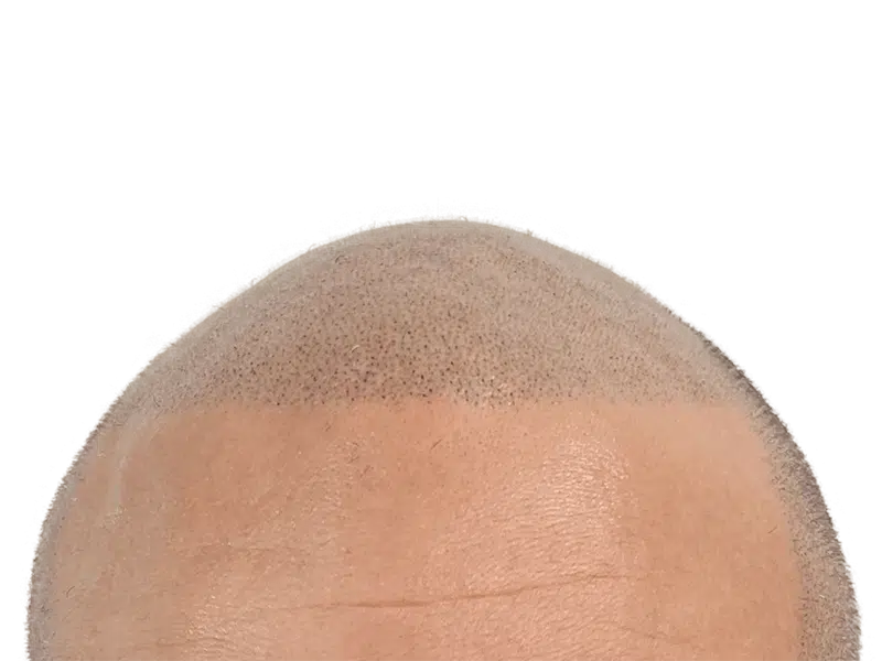 Hair transplant result: New hairline with short, dense hair growth. Hair restoration procedure visible on light skin.