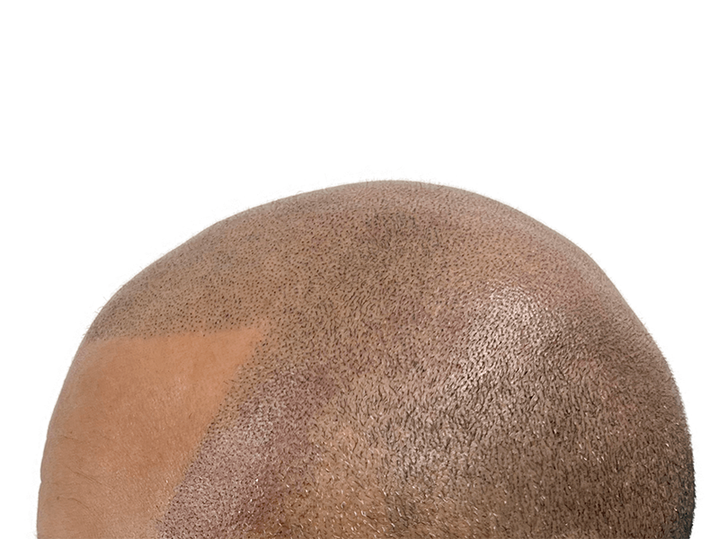 Hair transplant result: Dense, dark hair growth on man's head. Improved hair density after restoration procedure.