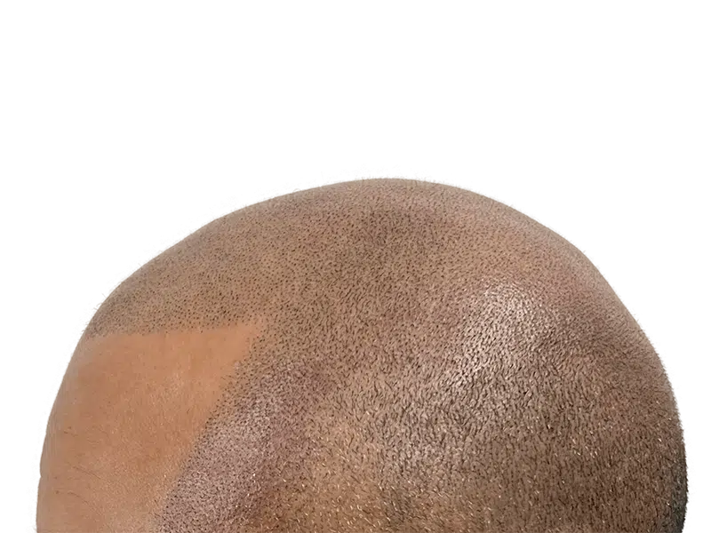 Hair transplant result: Dense, dark hair growth on man's head. Improved hair density after restoration procedure.