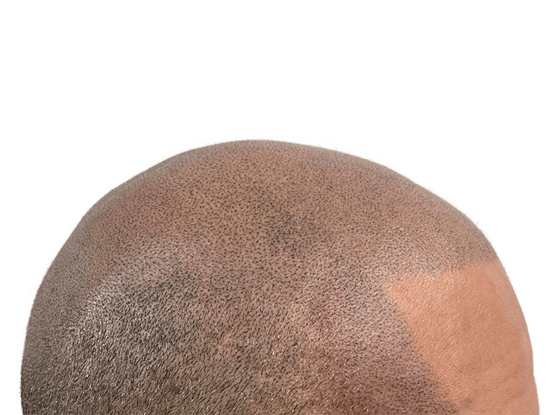 Hair transplant result: Dense, even hair growth on a light-skinned head. Successful hair restoration procedure.