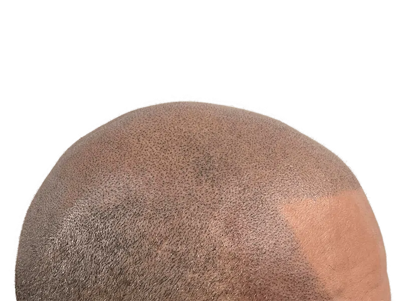 Hair transplant result: Dense, even hair growth on a light-skinned head. Successful hair restoration procedure.