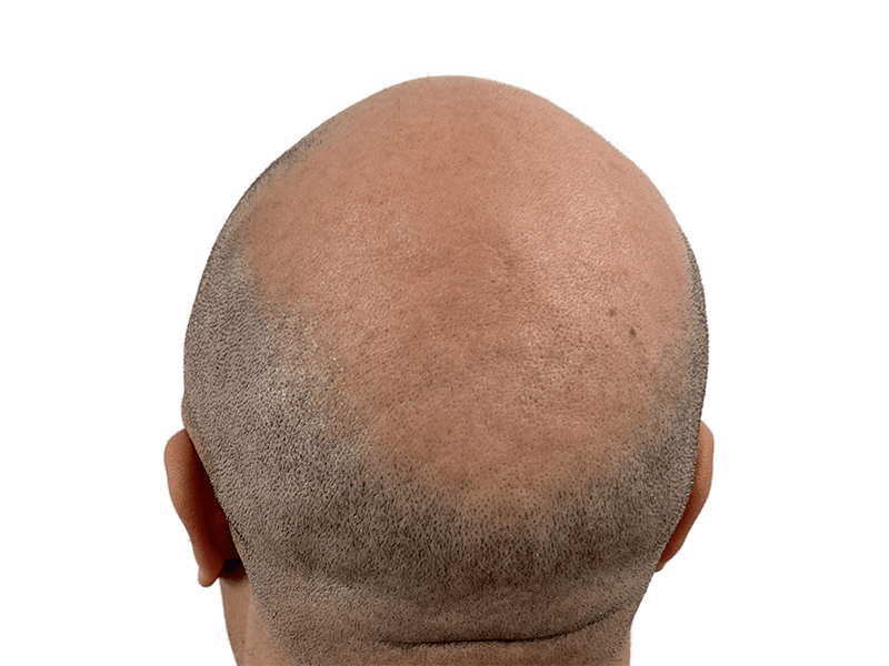 Balding scalp. Hair loss on crown and back of head. Potential hair restoration candidate. Before hair transplant.
