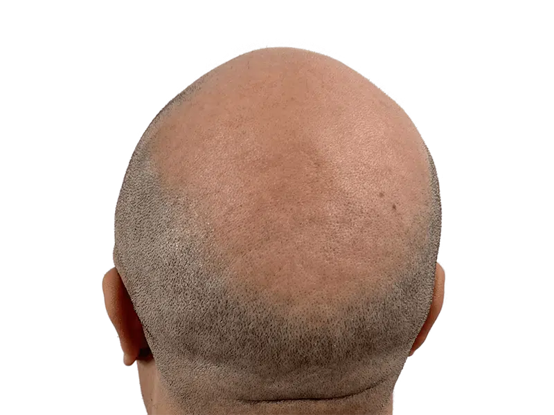Balding scalp. Hair loss on crown and back of head. Potential hair restoration candidate. Before hair transplant.