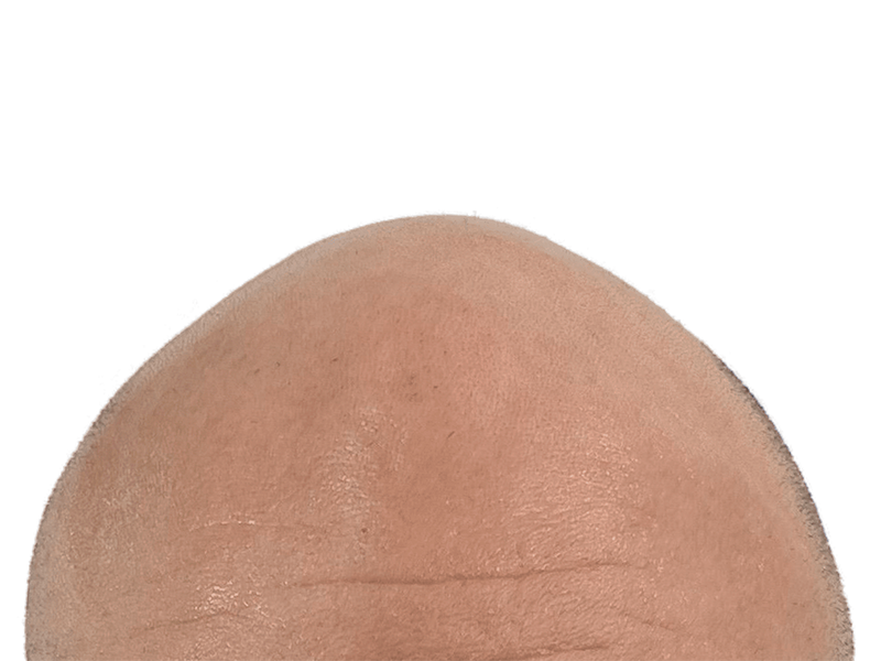Bald head close-up. Hair transplant candidate? Before hair restoration. Smooth skin, black background.