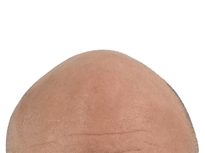 Bald head close-up. Hair transplant candidate? Before hair restoration. Smooth skin, black background.