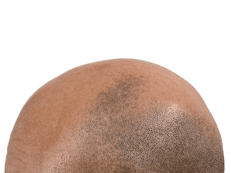 Hair loss in Black/Hispanic male. Possible hair transplant candidate. Before/after comparison needed for assessment.